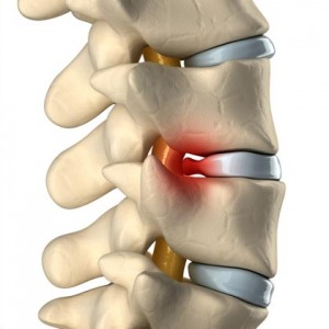 Spinal decompression