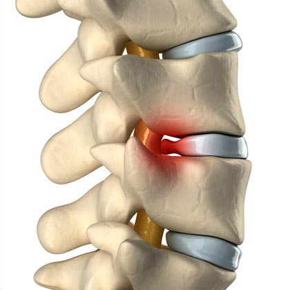 Spinal decompression